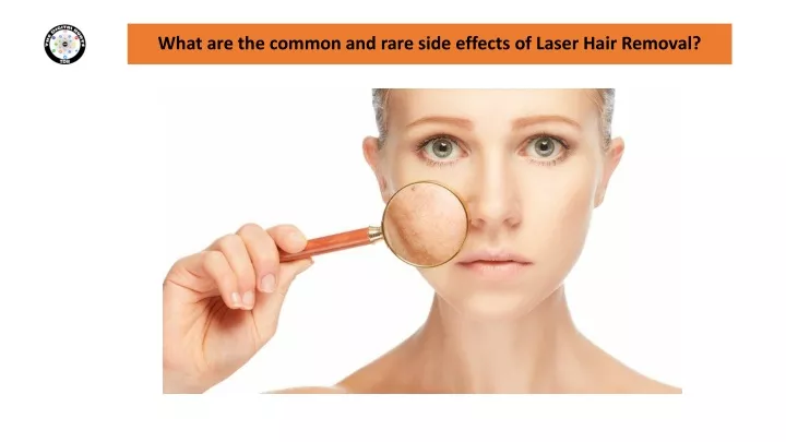 Ppt What Are The Common And Rare Side Effects Of Laser Hair Removal