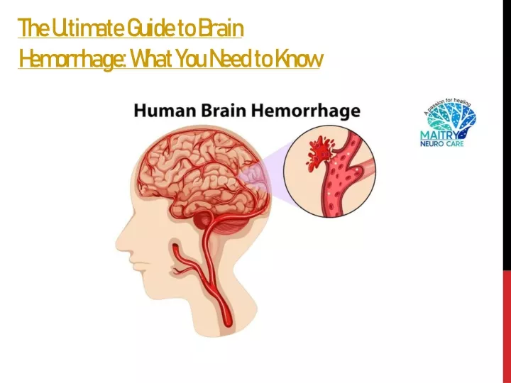 the ultimate guide to brain hemorrhage what