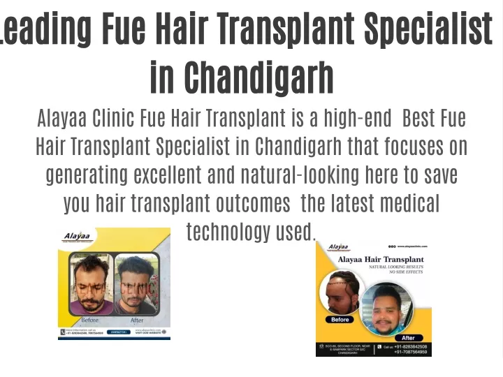 leading fue hair transplant specialist