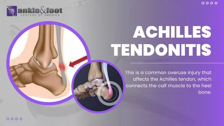 achilles tendonitis