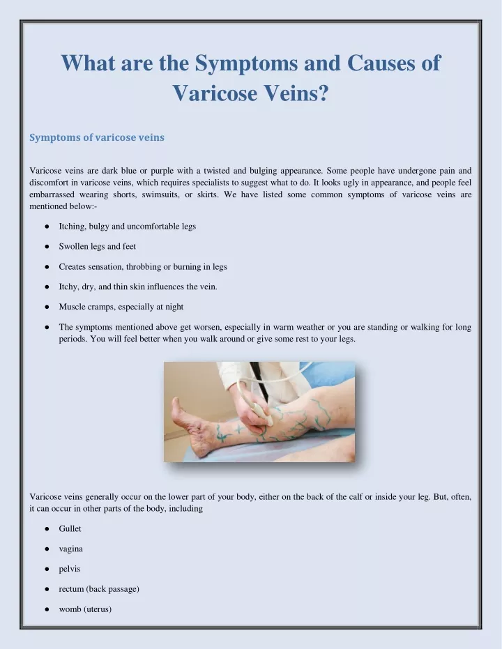 what are the symptoms and causes of varicose veins