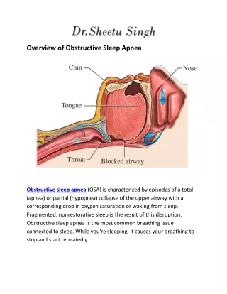 Overview of Obstructive Sleep Apnea