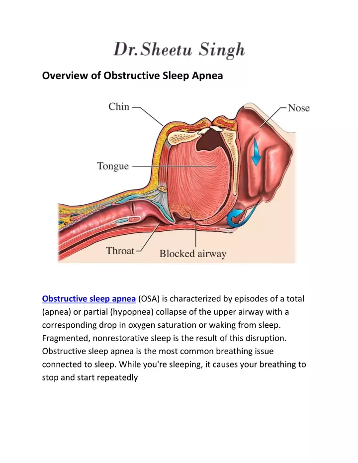 overview of obstructive sleep apnea