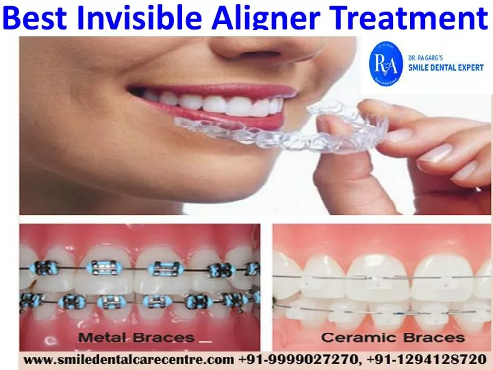 best invisible aligner treatment