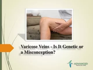Varicose Veins - Is It Genetic or a Misconception?