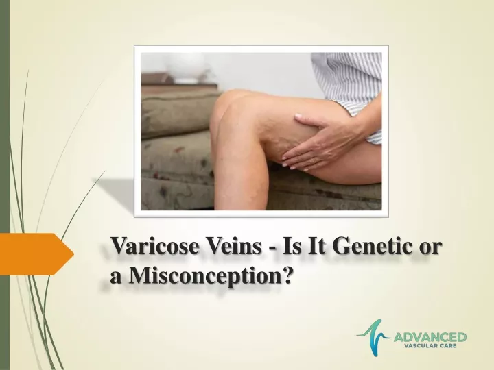 varicose veins is it genetic or a misconception