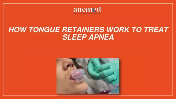 how tongue retainers work to treat sleep apnea