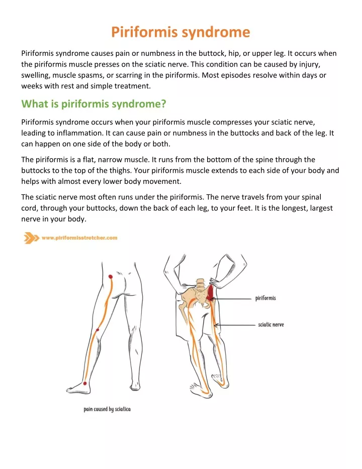 piriformis syndrome