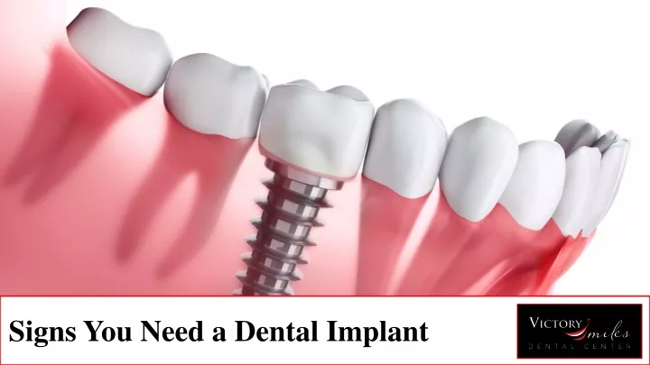 signs you need a dental implant