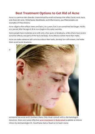 Best Treatment Options to Get Rid of Acne