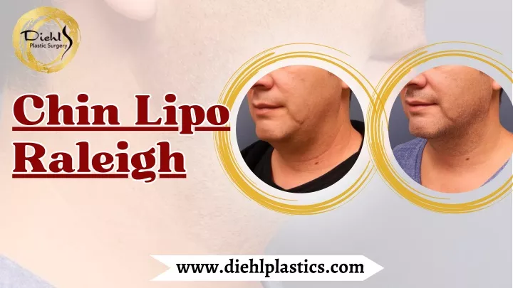 chin lipo raleigh raleigh