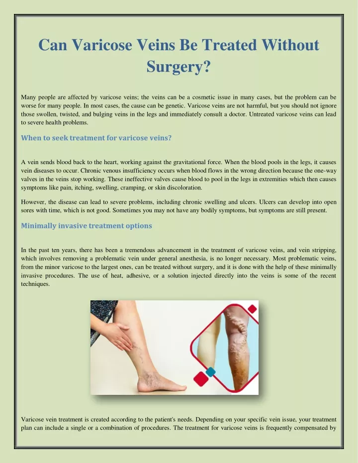 can varicose veins be treated without surgery