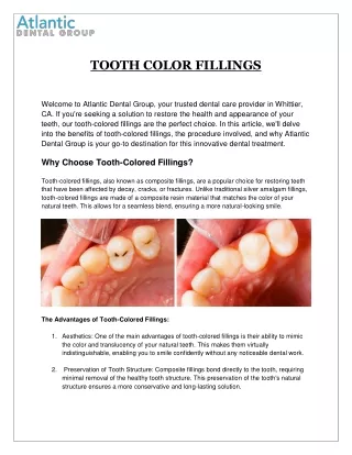 Enhance Your Smile with Tooth-Colored Fillings