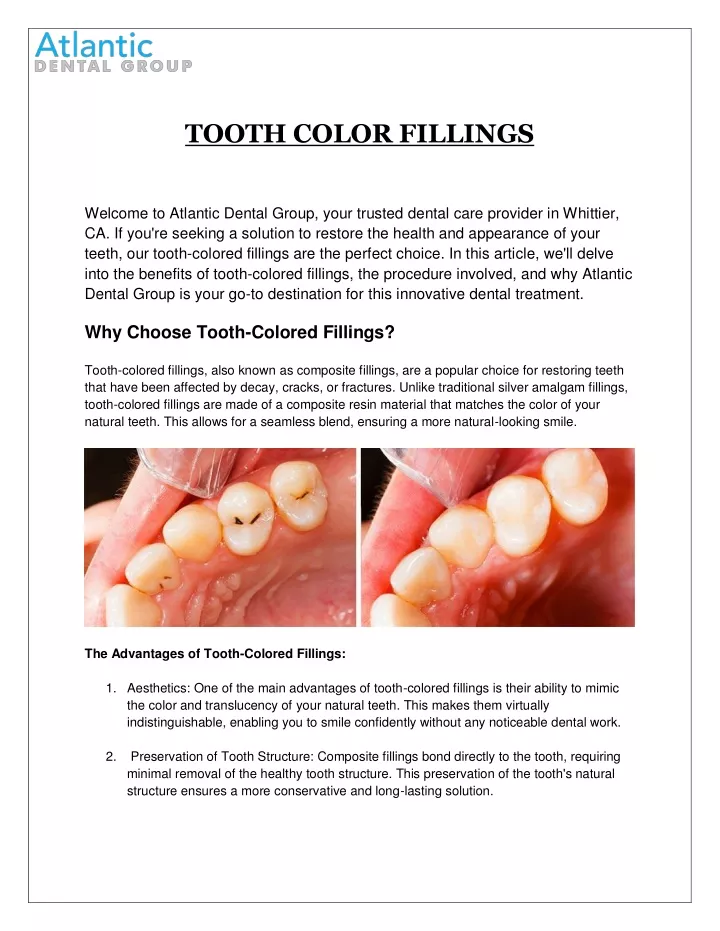 tooth color fillings