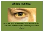 Herbal Remedies to Fight the Jaundice Disorder - slide 1