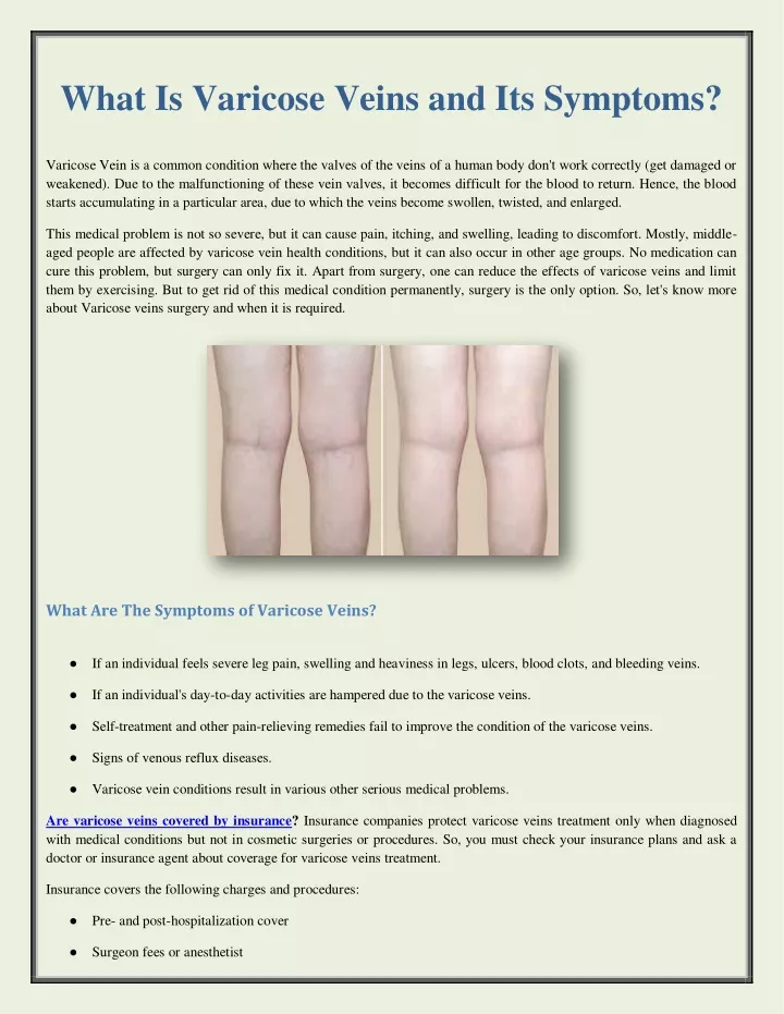 what is varicose veins and its symptoms