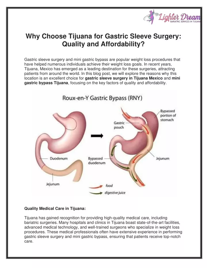 why choose tijuana for gastric sleeve surgery