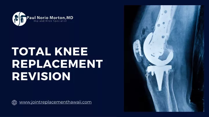 total knee replacement revision