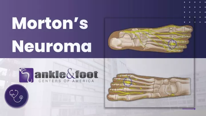 morton s neuroma