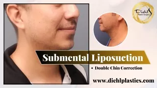 Submental Liposuction for a Defined Jawline and Neck Contour