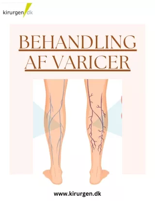 behandling af varicer