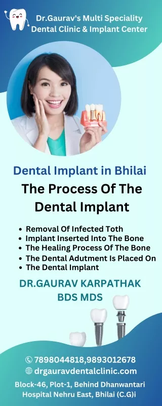 dental implant in bhilai