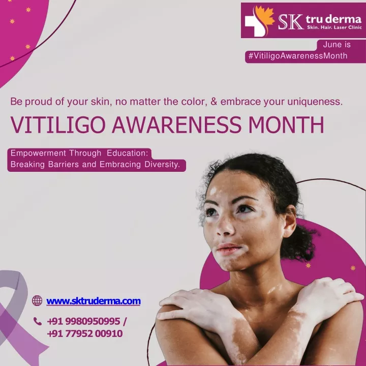 be proud of your skin no matter the color embrace your uniqueness vitiligo awareness month
