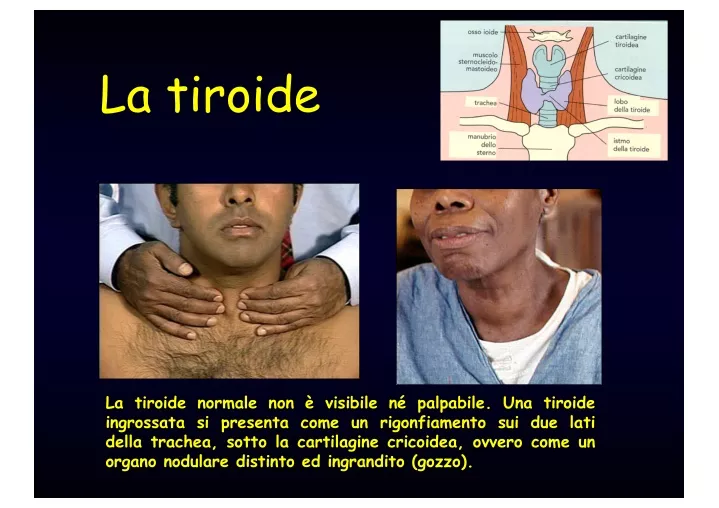 la tiroide