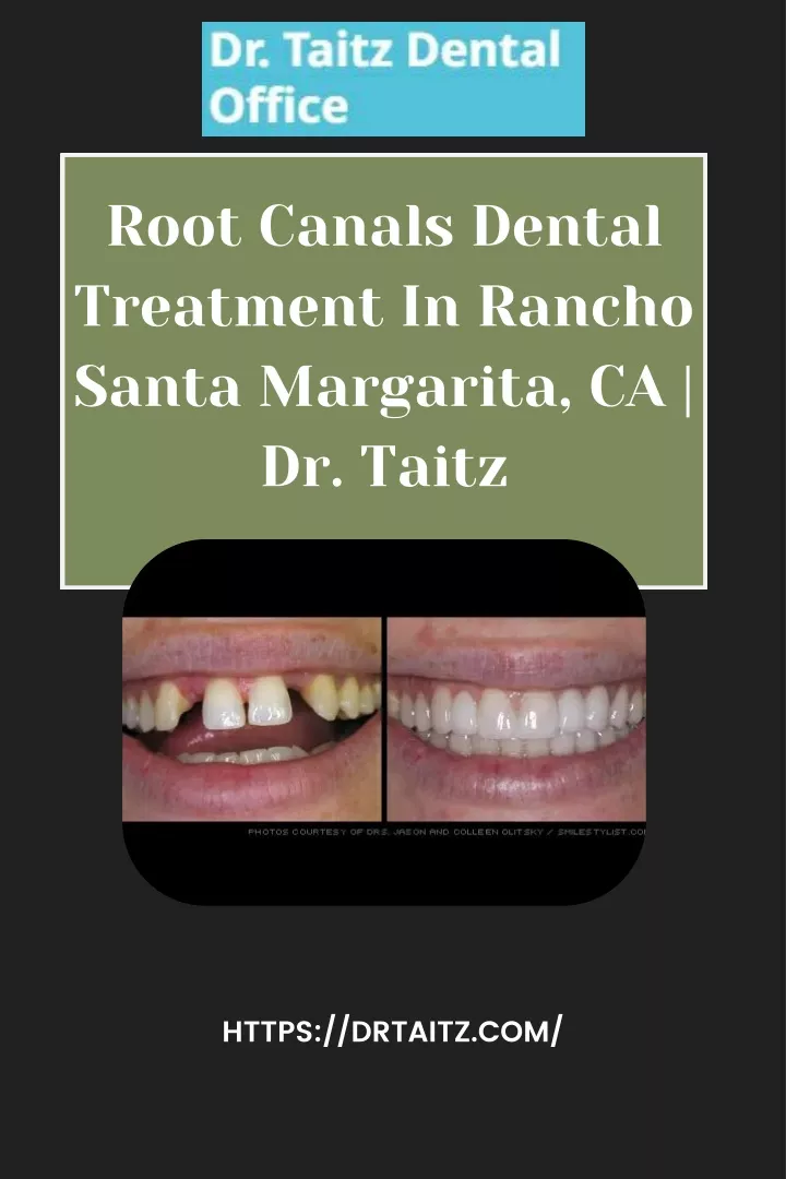 root canals dental treatment in rancho santa
