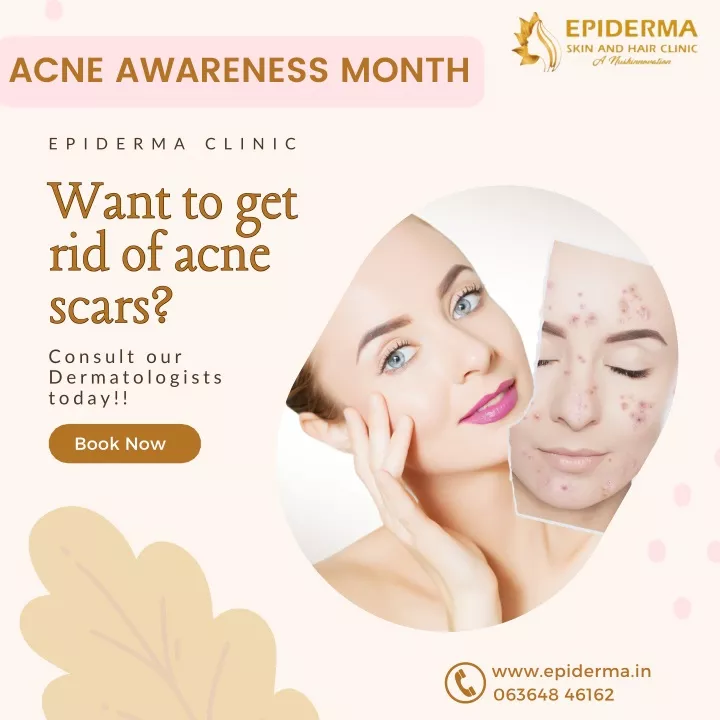 Ppt Get Rid Of Acne Scars Epiderma Skin And Hair Clinic Jayanagar Bangalore Powerpoint 0782