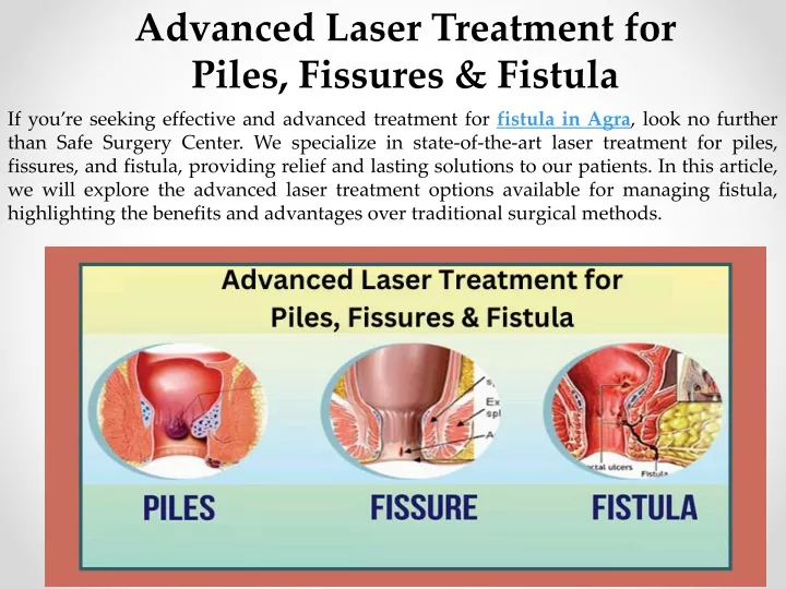 advanced laser treatment for piles fissures