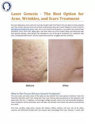 Laser Genesis — The Best Option For Acne, Wrinkles, And Scars Treatment