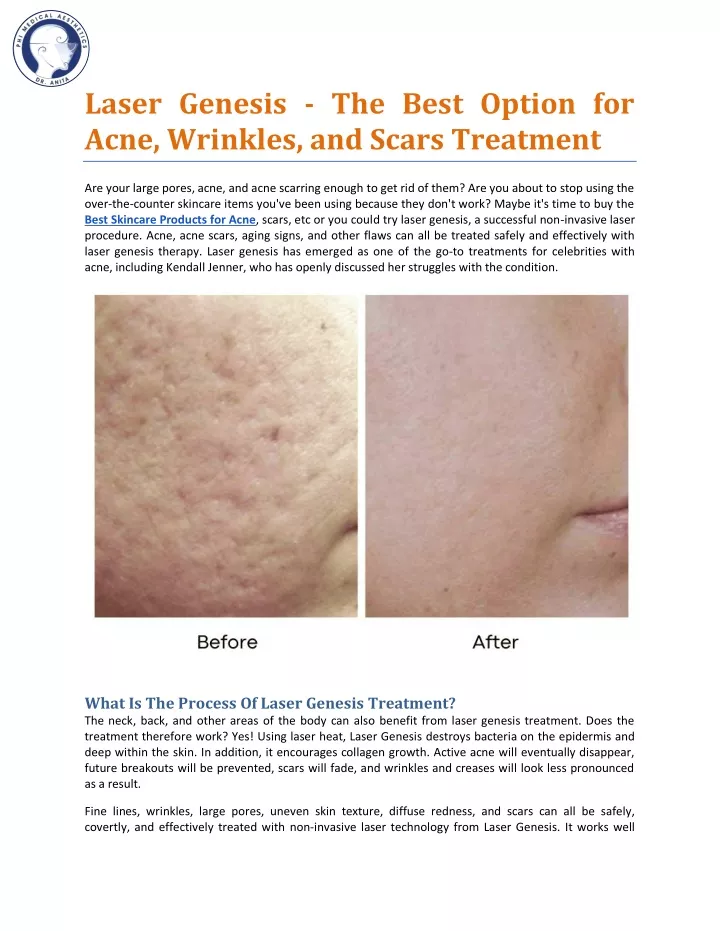 laser genesis the best option for acne wrinkles