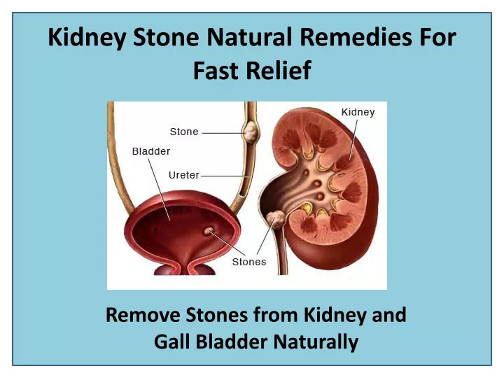 kidney stone natural remedies for fast relief
