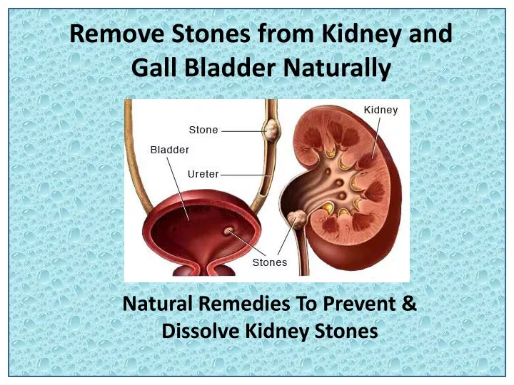 remove stones from kidney and gall bladder naturally