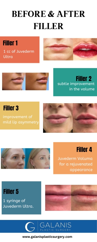 Before & After Filler - Dr. Galanis