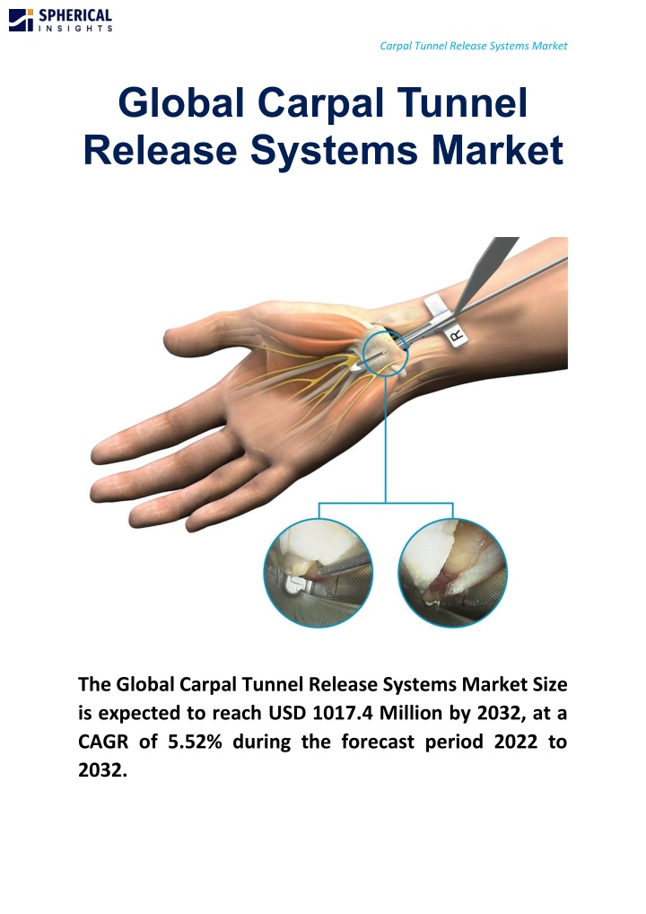 carpal tunnel release systems market