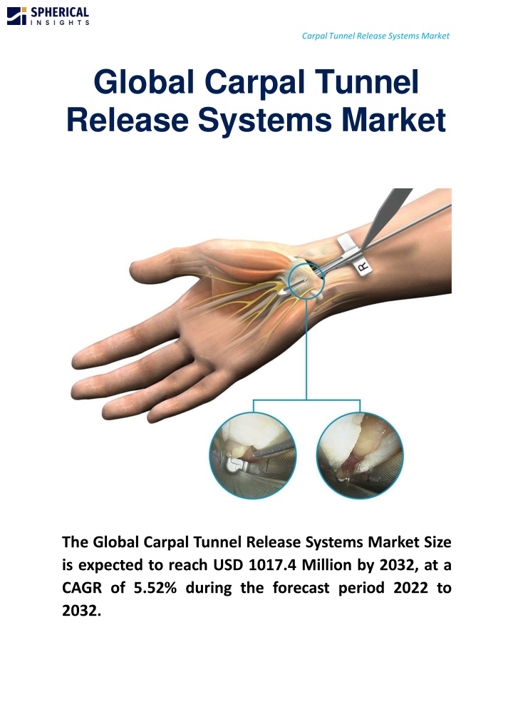 global carpal tunnel release systems market