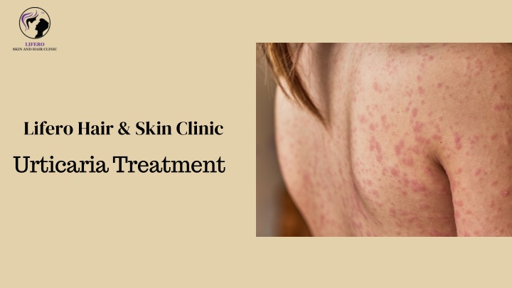 lifero hair skin clinic urticaria treatment