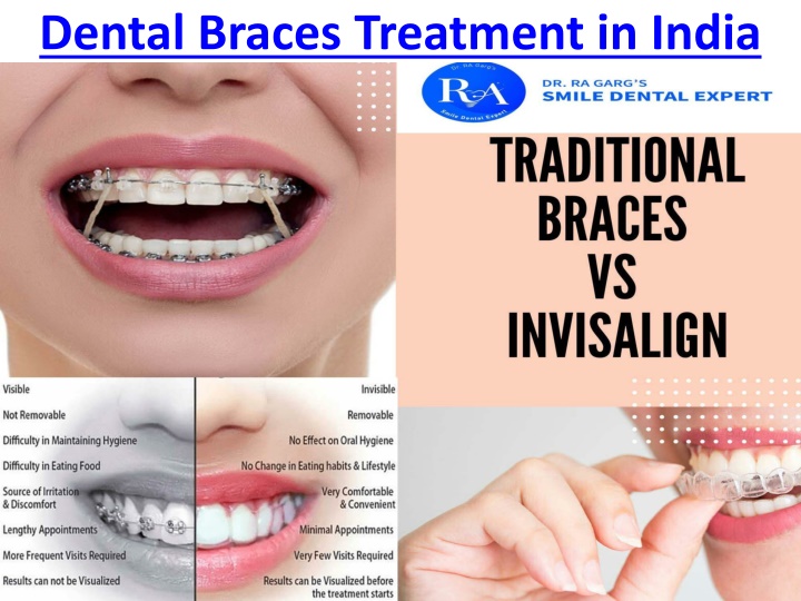 dental braces treatment in india