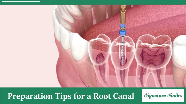 preparation tips for a root canal