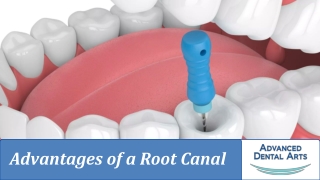 Reasons to Consider a Root Canal: Preserving Your Dental Health