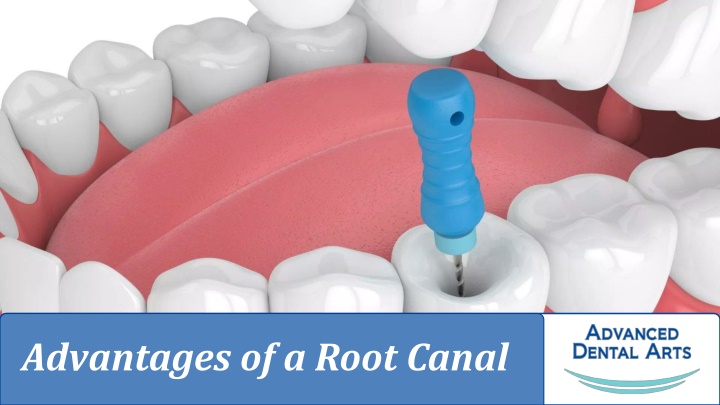 advantages of a root canal