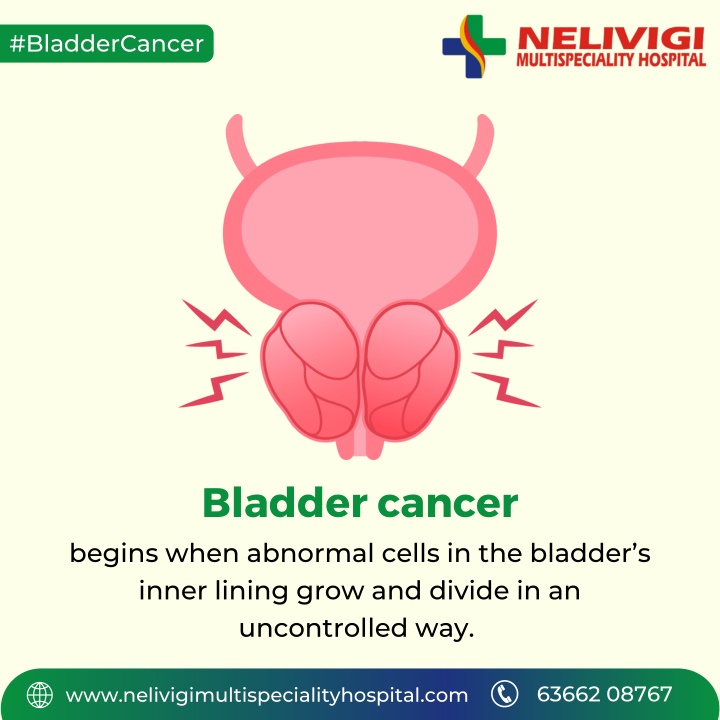 Ppt What Is Bladder Cancer Best Urology Hospitals In Bellandur Nelivigi Urology Powerpoint