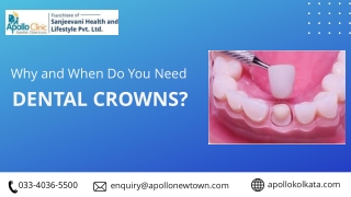 Why and When Do You Need Dental Crowns?