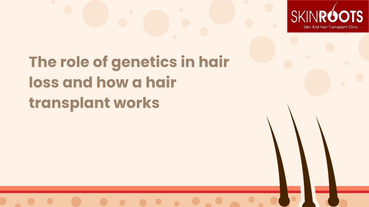 the role of genetics in hair loss and how a hair transplant works
