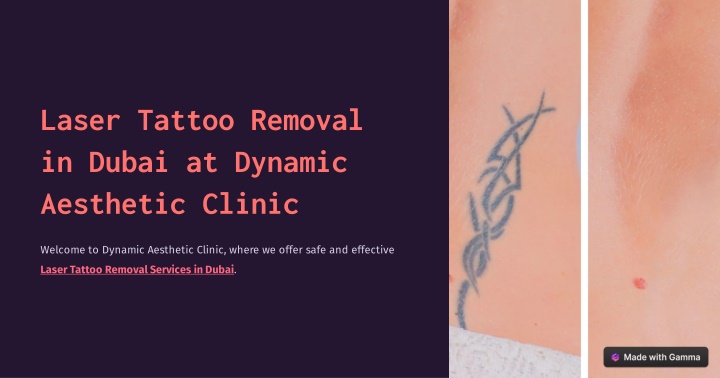 laser tattoo removal in dubai at dynamic