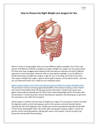 How to Choose the Right Weight Loss Surgery for You