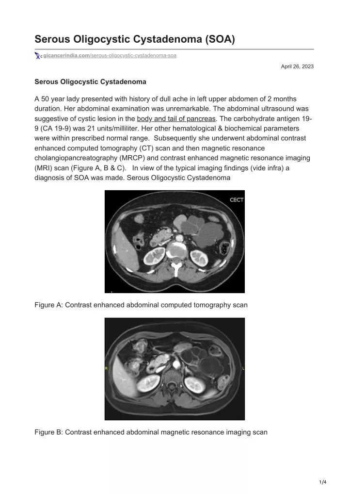 serous oligocystic cystadenoma soa