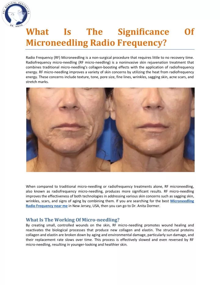 what microneedling radio frequency